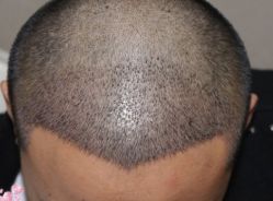 -大麦微针植发丨全国连锁