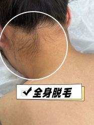 -小梨·OndaPro·专业脱毛连锁机构