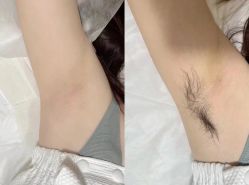 -薇兰专业脱毛连锁机构