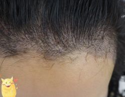 -大麦微针植发丨全国连锁