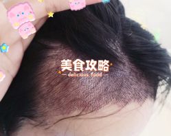 -大麦微针植发全国连锁