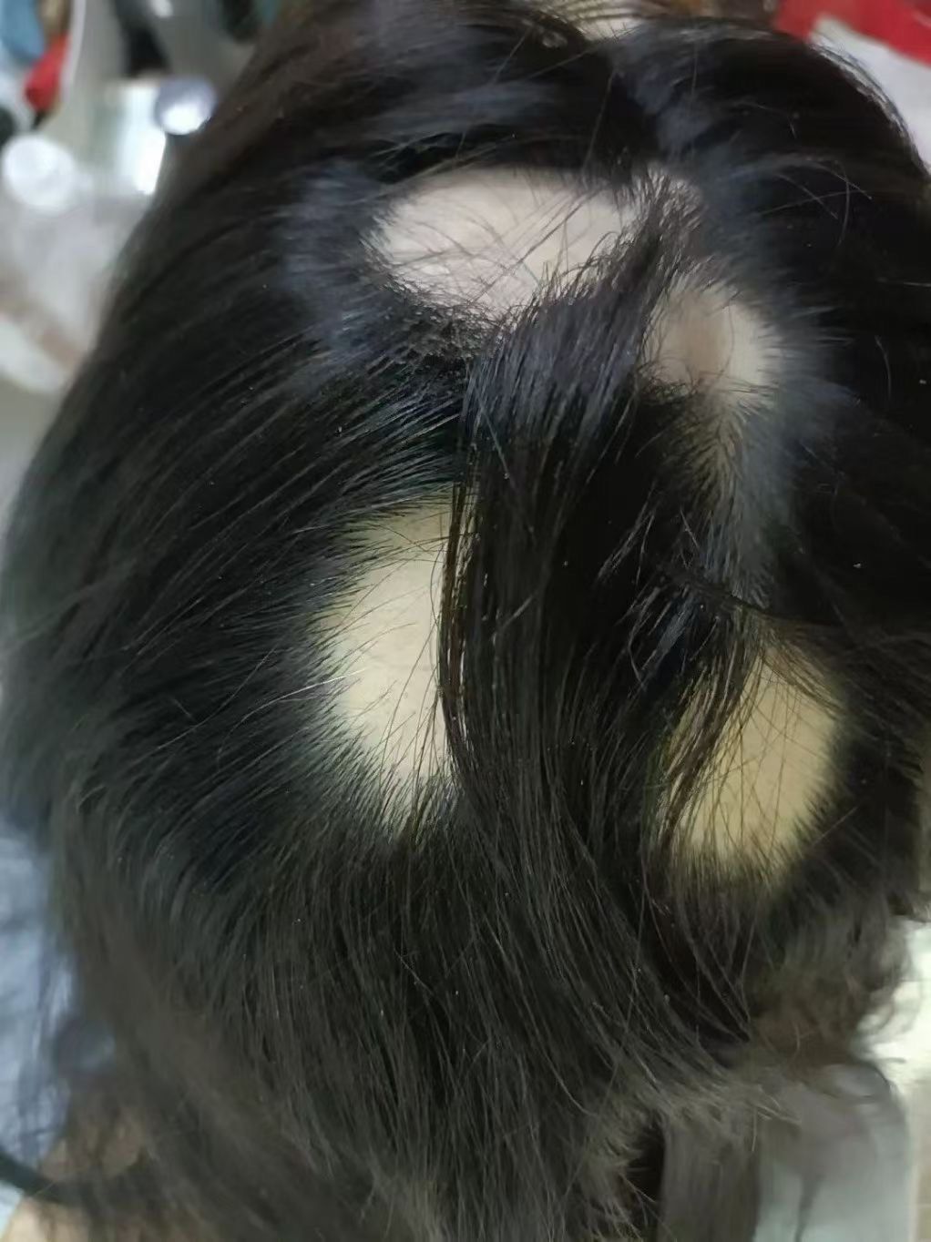 斑秃  
这是一种临床常见的