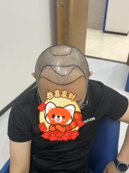 -大麦微针植发全国连锁