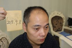 -大麦微针植发丨全国连锁