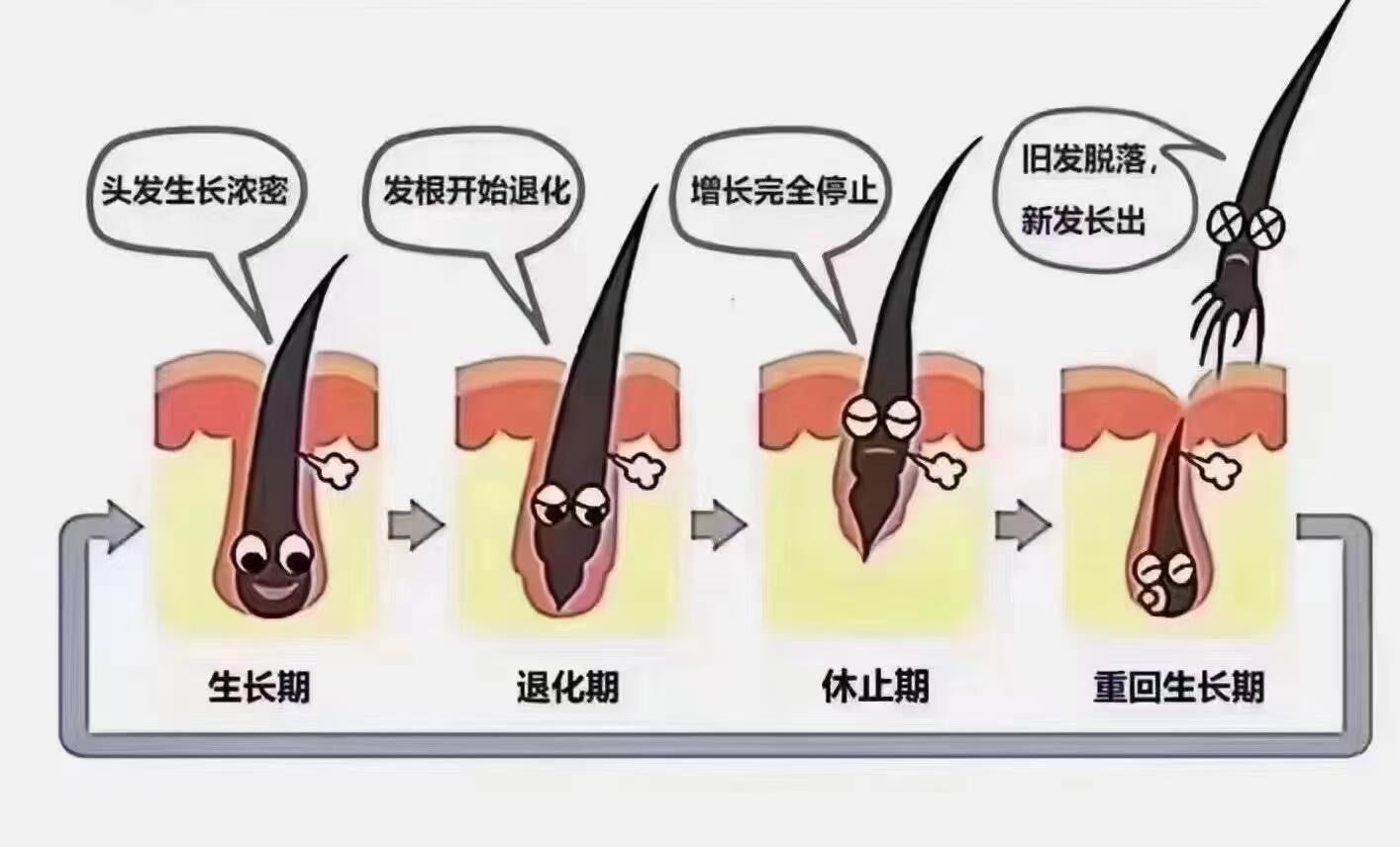 家族遗传导致的脱发,如雄性激素源性脱发