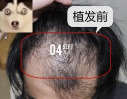 -大麦微针植发全国连锁