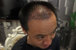 点击看大图 -大麦微针植发丨全国连锁