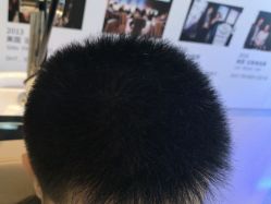 -碧莲盛·不剃发植发