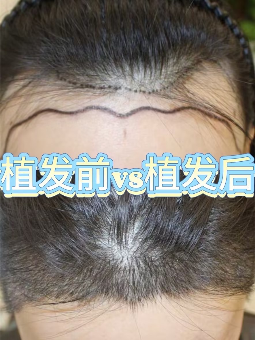 植发满头血吗(植发时出血较多怎么回事)