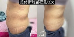 -苗塑堂减肥·艾灸