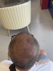 -大麦微针植发全国连锁