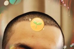 -大麦微针植发全国连锁