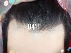 -大麦微针植发全国连锁