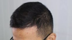 -大麦微针植发全国连锁