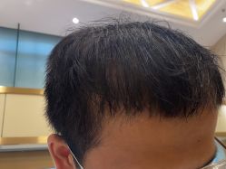 点击看大图 -碧莲盛·不剃发植发