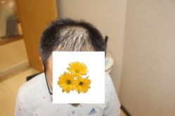 -大麦微针植发丨全国连锁