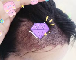 -大麦微针植发全国连锁