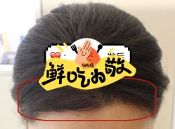 -大麦微针植发全国连锁