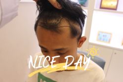 -大麦微针植发全国连锁