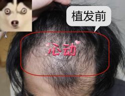 -大麦微针植发全国连锁