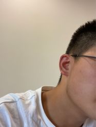 体验后-清疣美疣·痣·斑净肤中心