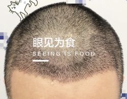 -大麦微针植发全国连锁