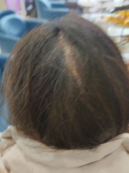 -碧莲盛·不剃发植发