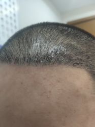 -大麦微针植发全国连锁