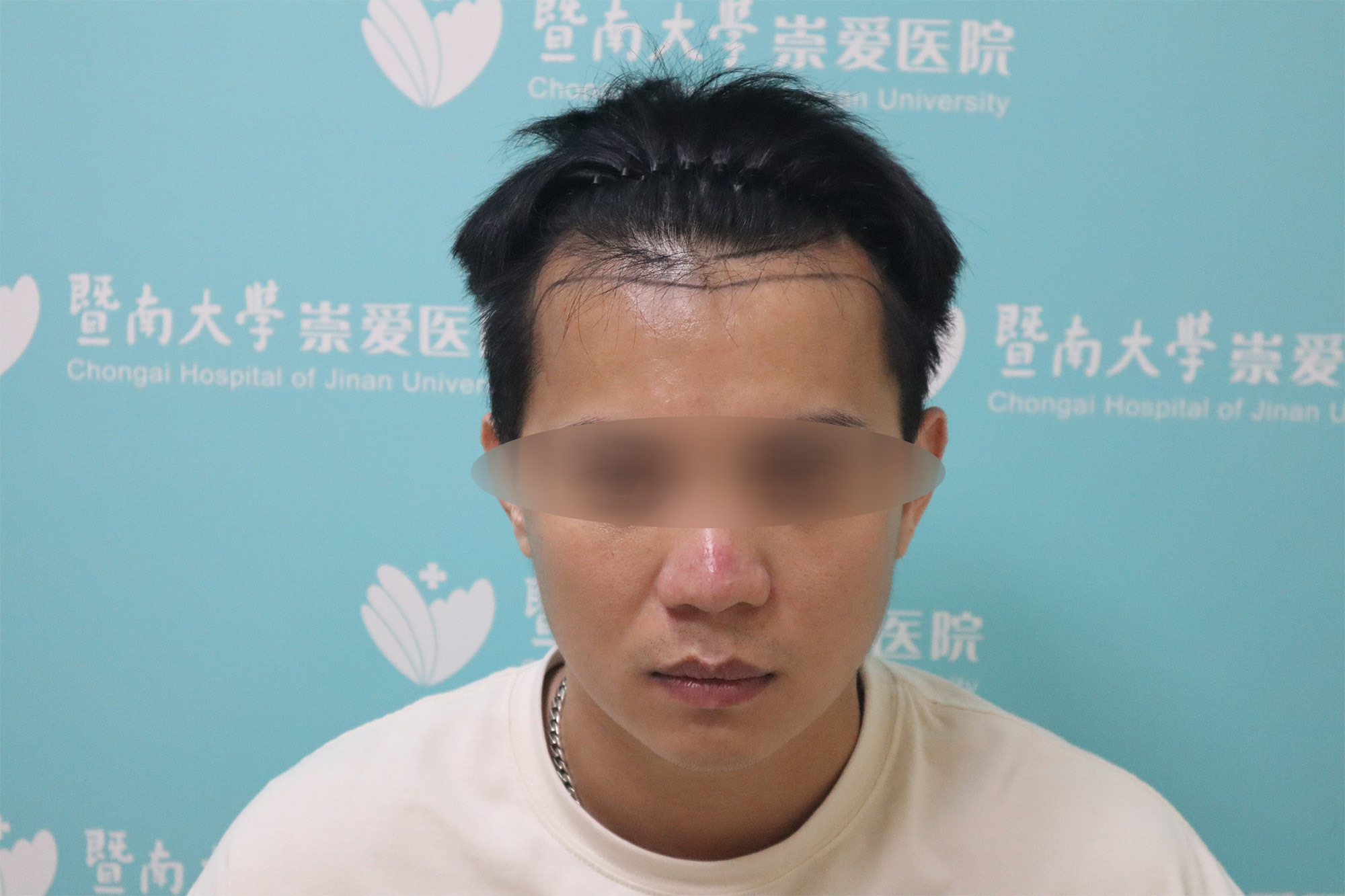 植发变帅后(植发后老了很难看)