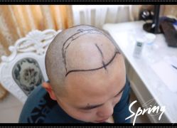 点击看大图 体验后-大麦微针植发全国连锁