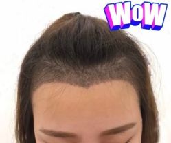 -大麦微针植发丨全国连锁