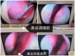 -貝康小儿推拿