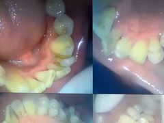 -赫尔森口腔·牙齿种植修复