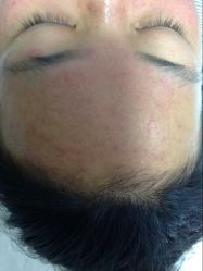 -苗方清颜专业祛痘