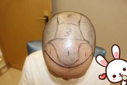 -大麦微针植发丨全国连锁