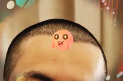 -大麦微针植发全国连锁