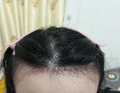 -碧莲盛·脱发养发中心