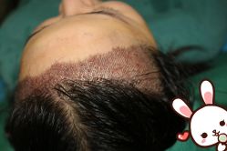 -大麦微针植发丨全国连锁