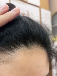 体验后-熙朵美学植发·连锁品牌