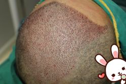 点击看大图 -大麦微针植发丨全国连锁