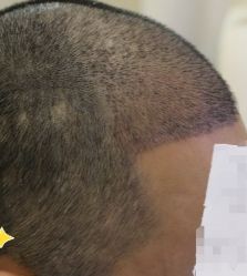 -大麦微针植发丨全国连锁