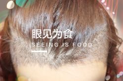 -大麦微针植发全国连锁