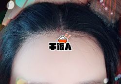 -大麦微针植发全国连锁