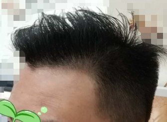 -大麦微针植发丨全国连锁