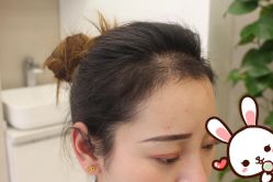 -大麦微针植发丨全国连锁