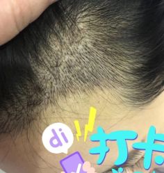 -大麦微针植发全国连锁