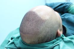 点击看大图 -大麦微针植发丨全国连锁