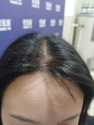 -碧莲盛·不剃发植发