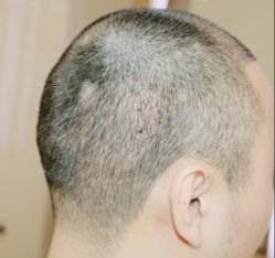-大麦微针植发全国连锁