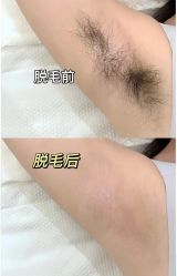 -薇兰专业脱毛连锁机构